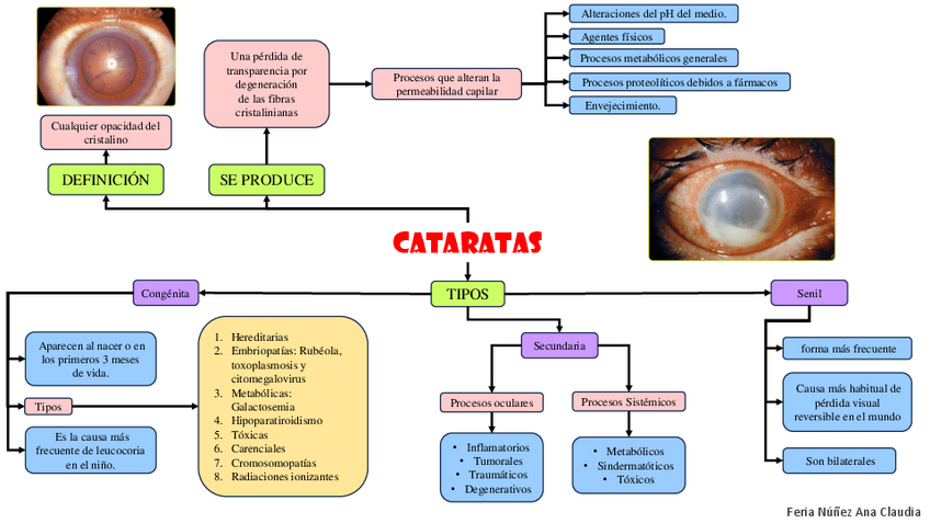 Miniatura del documento Apuntes de oftalmología:Catarata,retinopatia diabetica,toxocariasis y toxoplasmosis.pdf