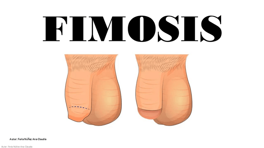 Miniatura del documento Fimosis.pdf