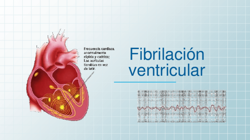 Miniatura del documento Fibrilacion-ventricular.pdf