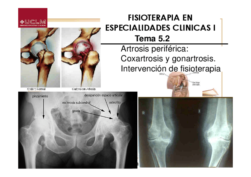 Miniatura del documento Tema-5.2-Artrosis-periferica-Coxartrosis-y-gonartrosis.-Intervencion-de-fisioterapia.pdf