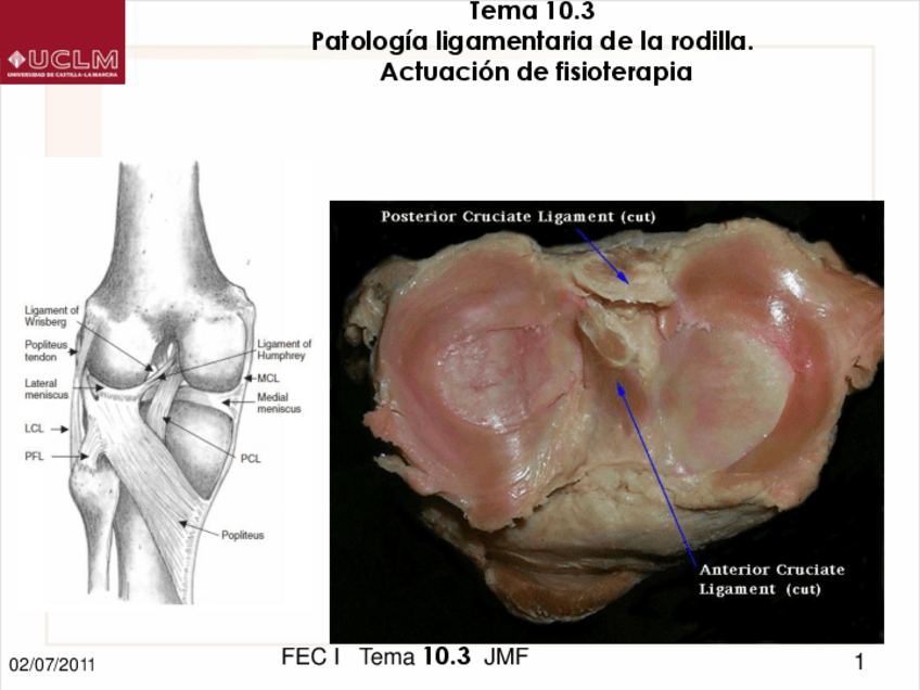 Miniatura del documento Tema-8.3-Patologia-ligamentaria-de-la-rodilla.-Actuacion-de-fisioterapia.pdf