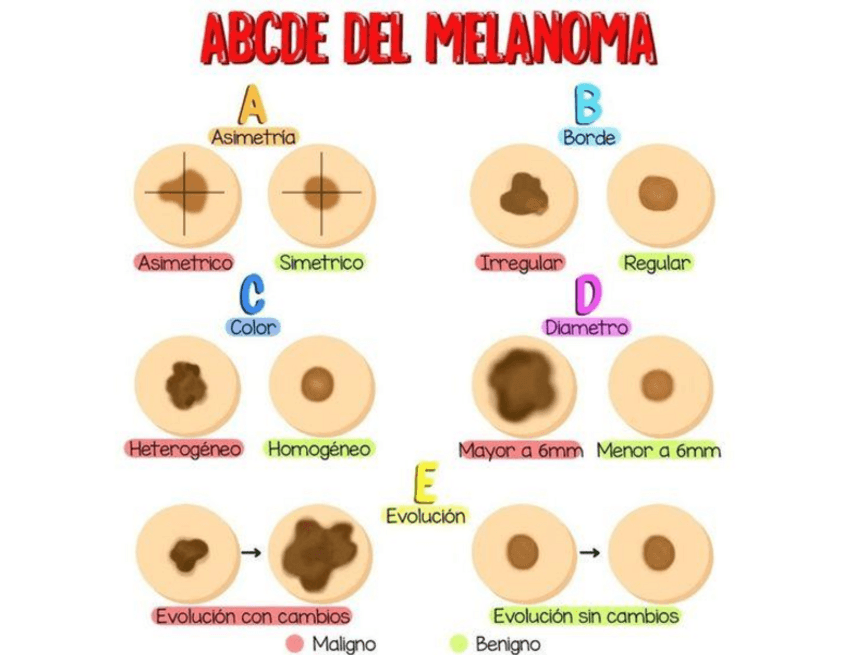 Miniatura del documento ABCDE-del-melanoma.pdf