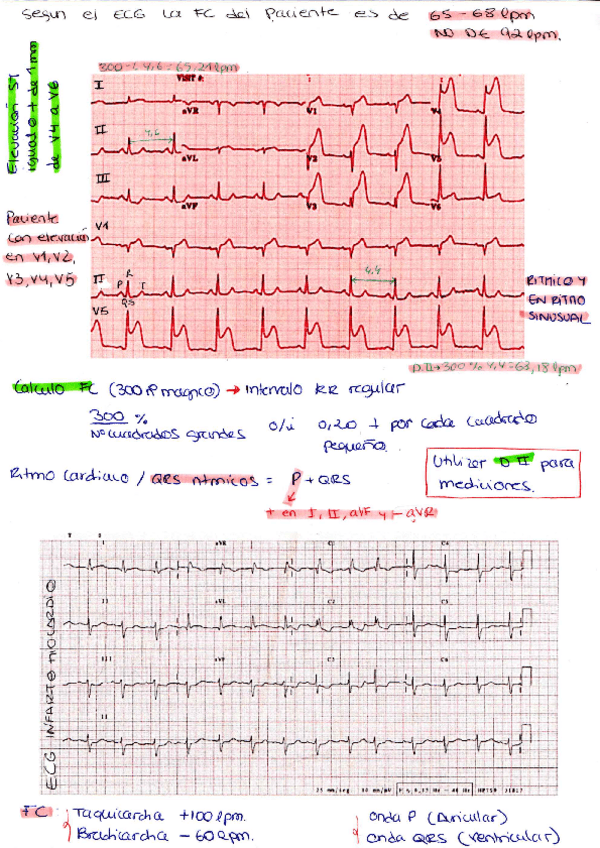 Miniatura del documento ECG-Caso-clinico.pdf