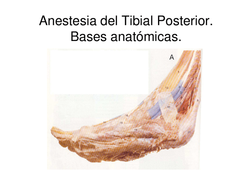 Miniatura del documento Tema-1-Anestesia-Tibial-Posterior.pdf