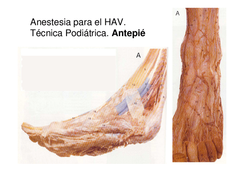 Miniatura del documento Tema-1.1-Anestesia-HAV-tecnica-podiatrica.pdf