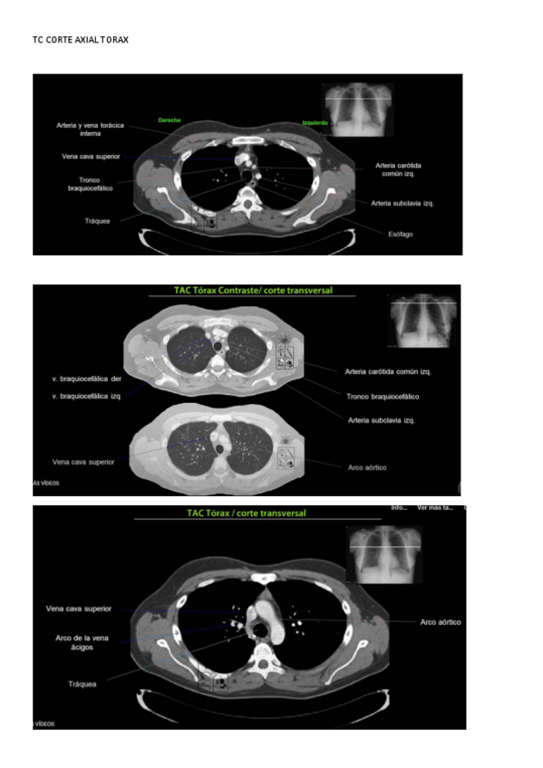 Miniatura del documento Imágenes TC corte axial UT5.pdf
