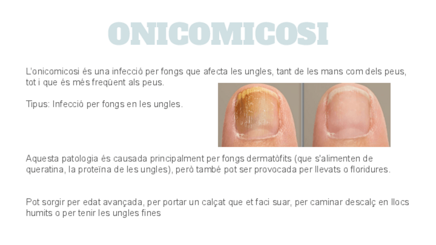 Miniatura del documento ONICOMICOSI.pdf