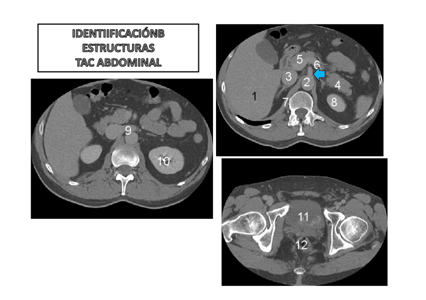 Miniatura del documento Urogenital-Identificacion-estructuras-TAC-y-RMN-sol.pdf