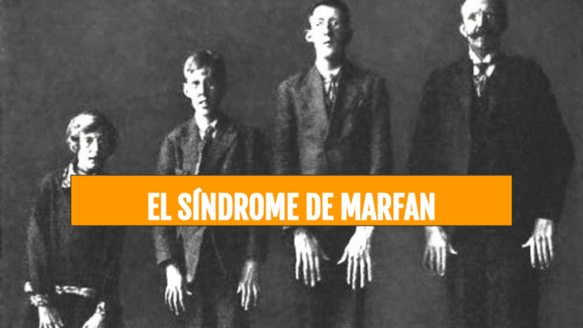 Miniatura del documento EL-SINDROME-DE-MARFAN.pdf