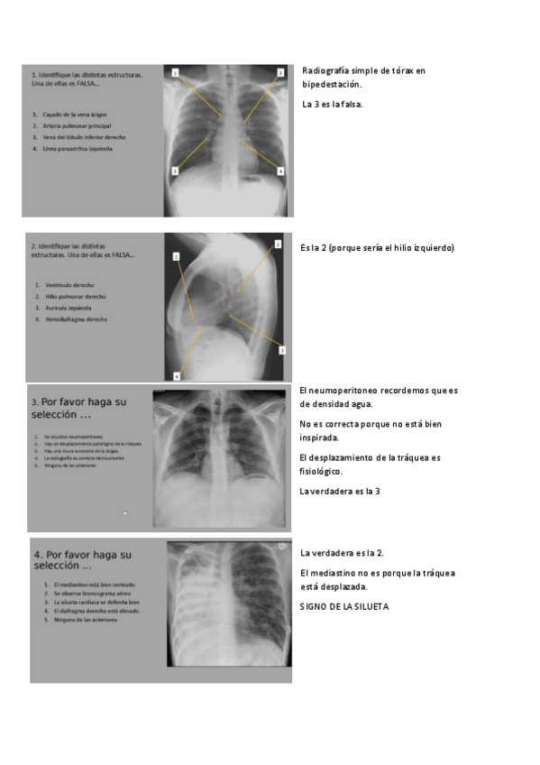 Miniatura del documento SEMINARIOS-RADIOLOGIA-TORAX.pdf
