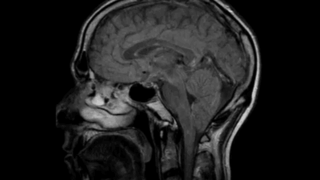 Miniatura del documento Brain-MRI-Multiple-Sclerosis-YouTube.flv