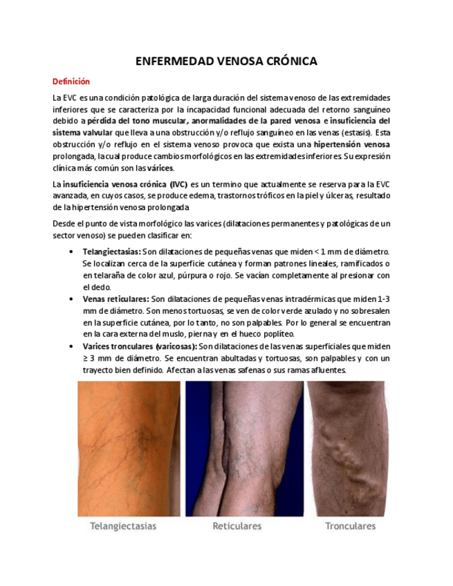 Miniatura del documento Insuficiencia-venosa-cronica.pdf