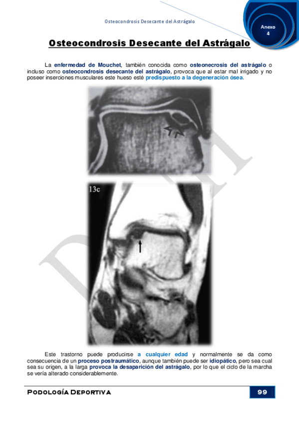 Miniatura del documento Anexo-4Osteocondrosis-Desecante-del-Astragalo.pdf