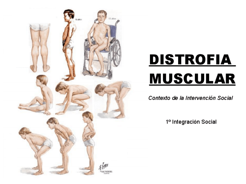 Miniatura del documento Power-point-Distrofia-muscular.pdf