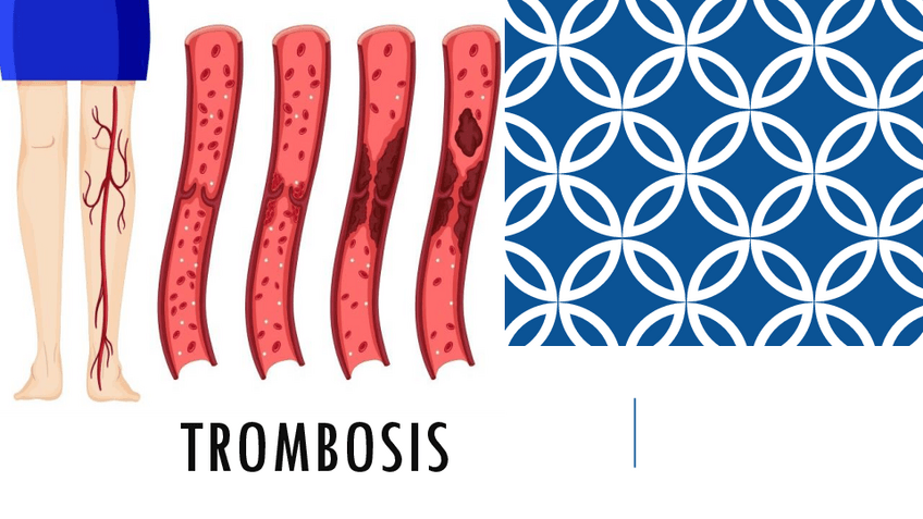 Miniatura del documento Trombosis-y-estado-protrombotico.pdf