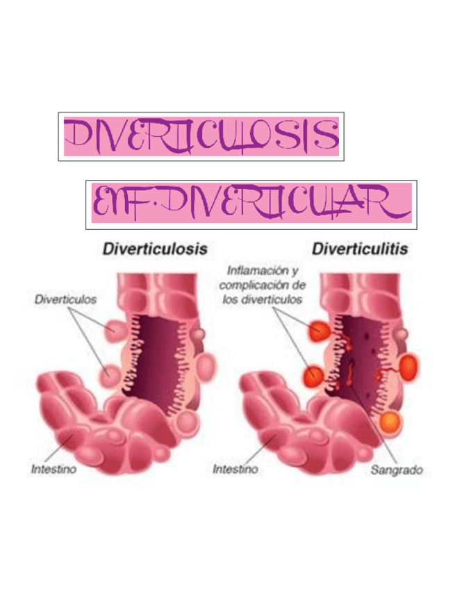 Miniatura del documento ENF-DIBERTICULAR-DIVERTICULOSIS-DIVERTICULITIS.pdf