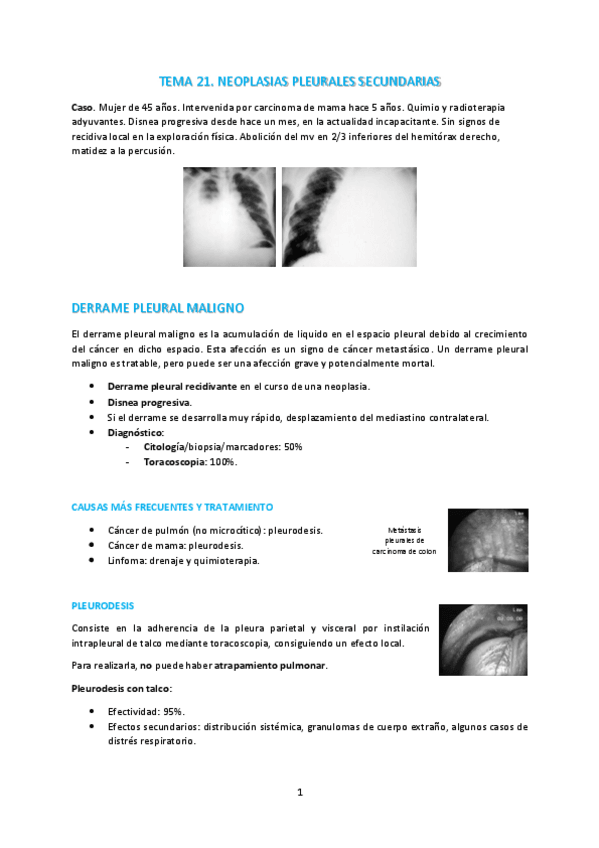 Miniatura del documento T21-Neoplasias-pleurales-secudarias.pdf