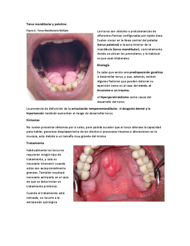 Miniatura del documento Torus-mandibular.pdf