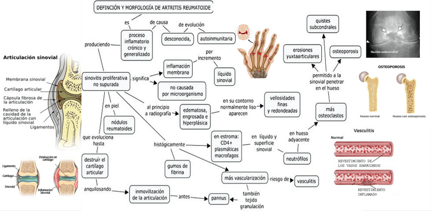 Miniatura del documento ARTRITIS-REUMATOIDE.pdf