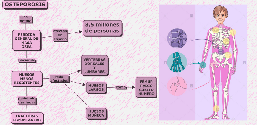 Miniatura del documento OSTEOPOROSIS.pdf