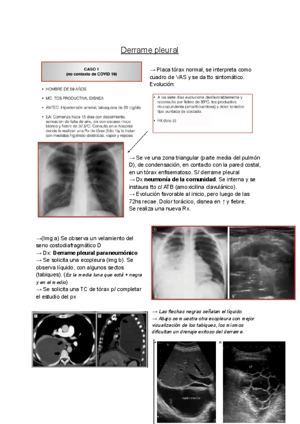 Miniatura del documento Derrame-pleural-.pdf