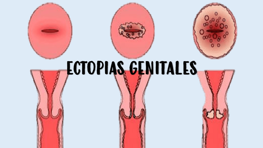 Miniatura del documento ECTOPIAS-GENITALES.pdf