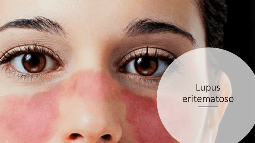 Miniatura del documento Lupus-eritematoso.pdf