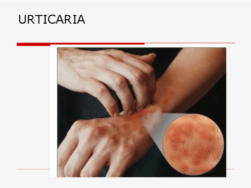 Miniatura del documento URTICARIA.pdf