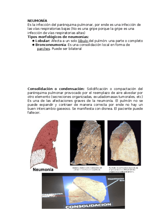 Miniatura del documento Neumonia.docx
