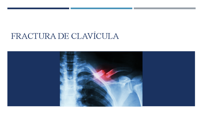 Miniatura del documento Fractura-de-Clavicula.pdf