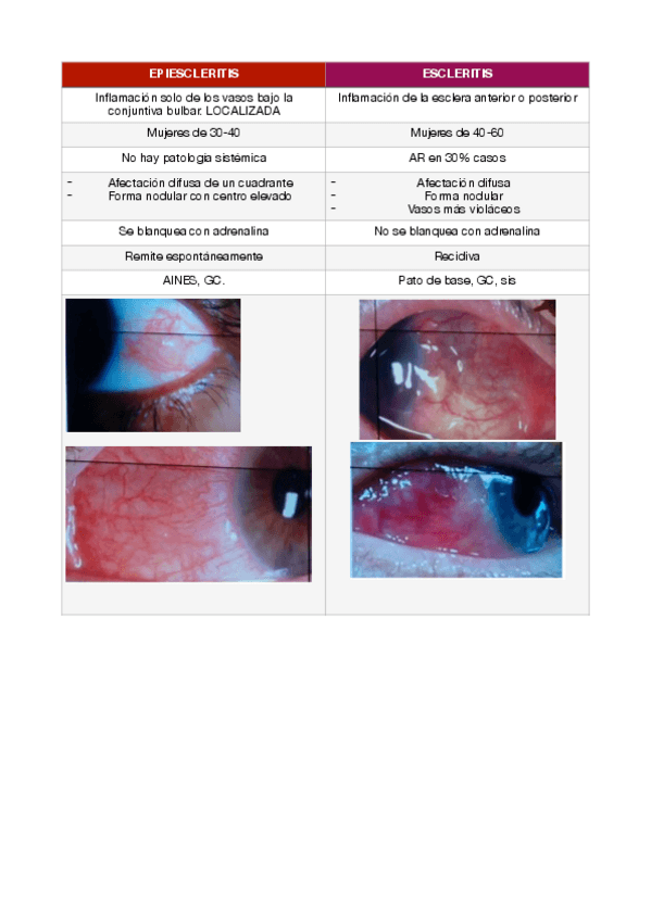 Miniatura del documento Epiescleritis-vs-escleritis.pdf