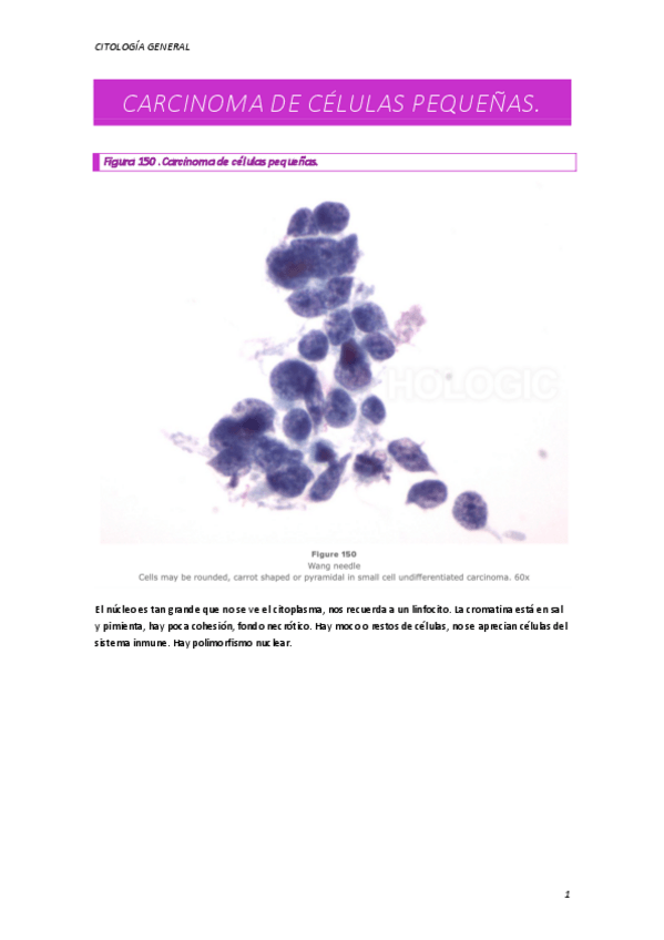 Miniatura del documento CARCINOMA-DE-CELULAS-PEQUENAS.pdf