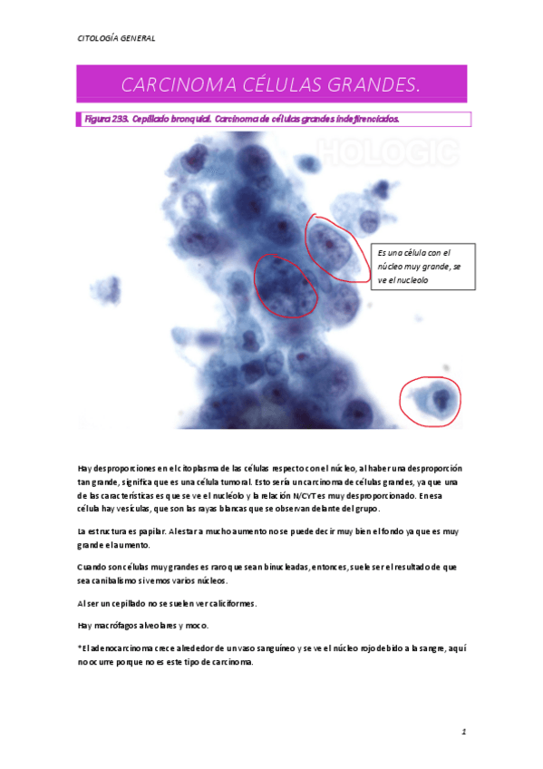 Miniatura del documento CARCINOMA-CELULAS-GRANDES.pdf