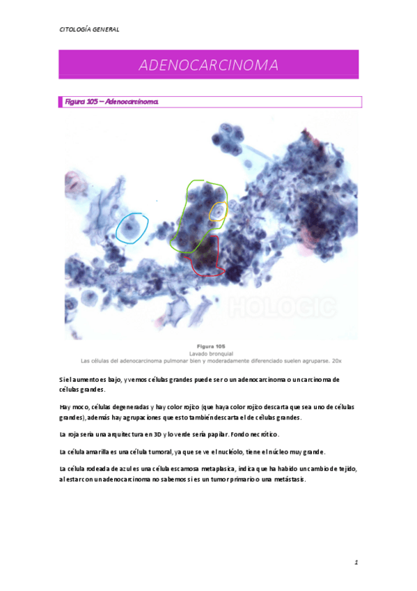 Miniatura del documento ADENOCARCINOMA.pdf