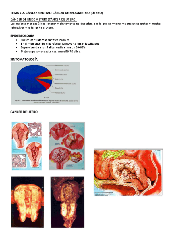 Miniatura del documento TEMA-7.2-CANCER-DE-ENDOMETRIO.pdf