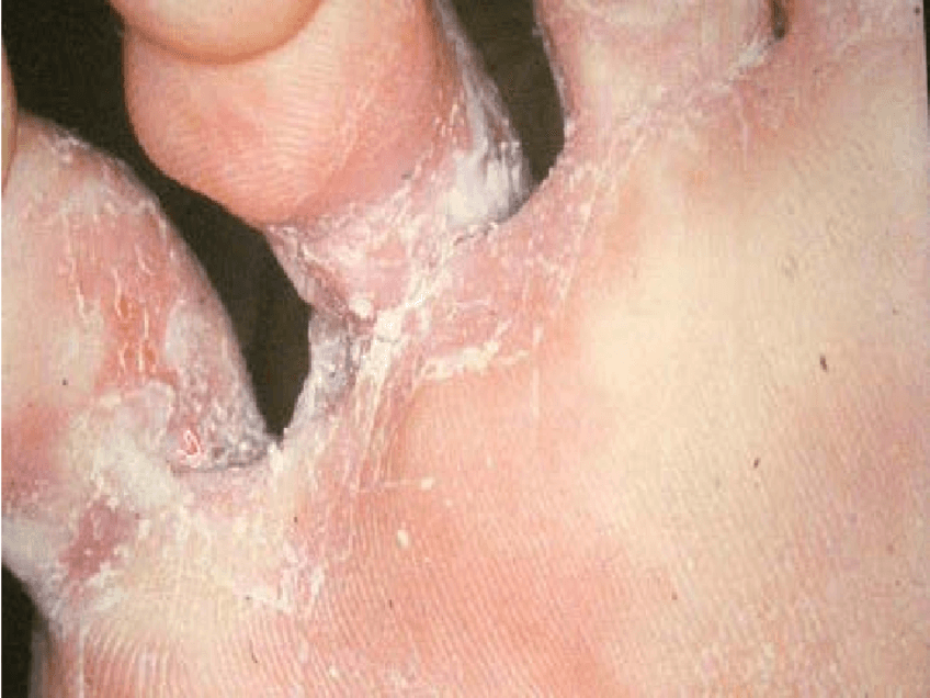Miniatura del documento T7-Dermatomicosis-2013-14-2.pdf