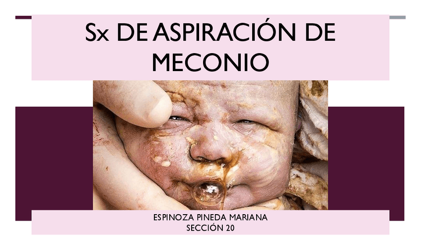 Miniatura del documento Sx-de-aspiracion-de-Meconio.pdf