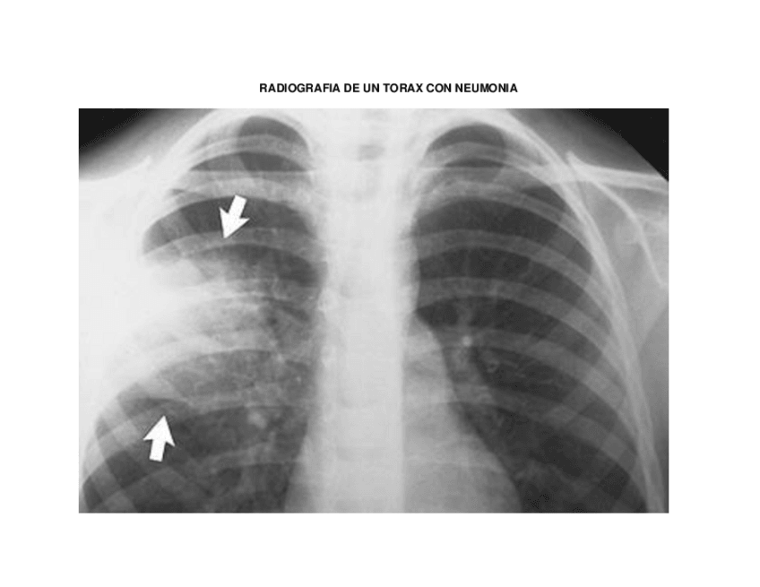 Miniatura del documento RADIOGRAFIA-DE-UN-TORAX-CON-NEUMONIA.pdf