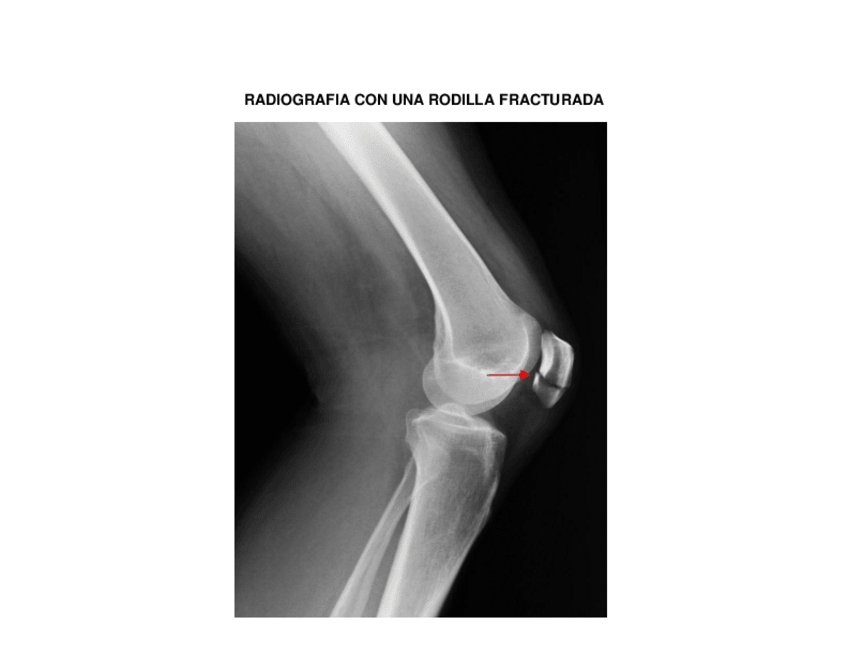 Miniatura del documento RADIOGRAFIA-CON-UNA-RODILLA-FRACTURADA.pdf