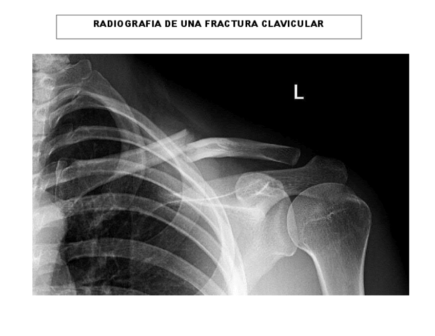 Miniatura del documento RADIOGRAFIA-DE-UNA-FRACTURA-CLAVICULAR.pdf
