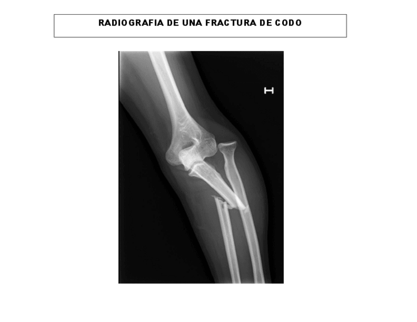 Miniatura del documento RADIOGRAFIA-DE-UNA-FACTURA-DE-CODO.pdf