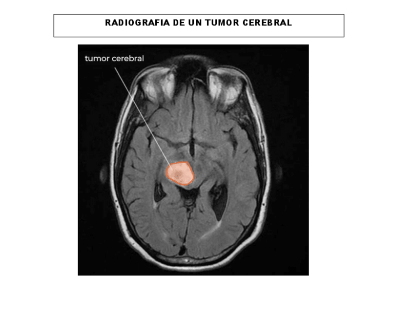 Miniatura del documento RADIOGRAFIA-DE-UN-TUMOR-CEREBRAL.pdf