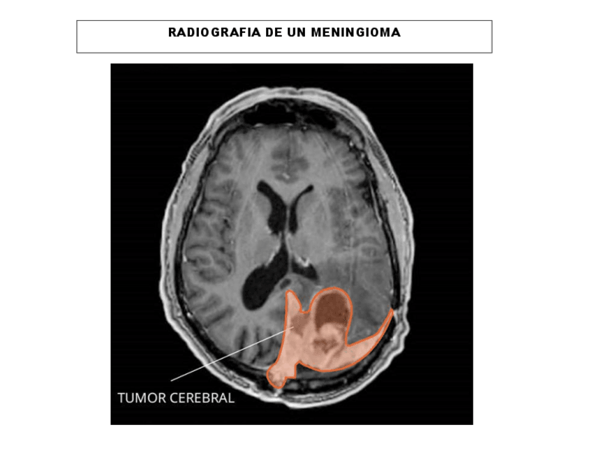 Miniatura del documento RADIOGRAFIA-DE-UN-MENINGIOMA.pdf