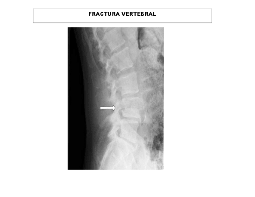 Miniatura del documento FRACTURA-VERTEBRAL.pdf