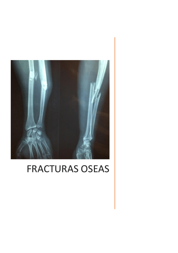 Miniatura del documento Fracturas-oseas.pdf