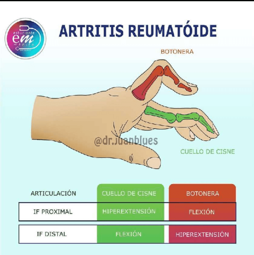 Miniatura del documento ARTRITIS-REUMATOIDE.pdf
