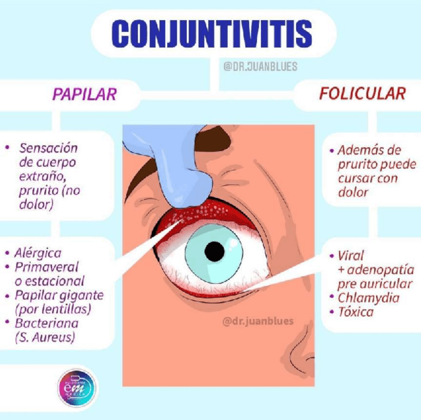 Miniatura del documento CONJUNTIVITIS.pdf
