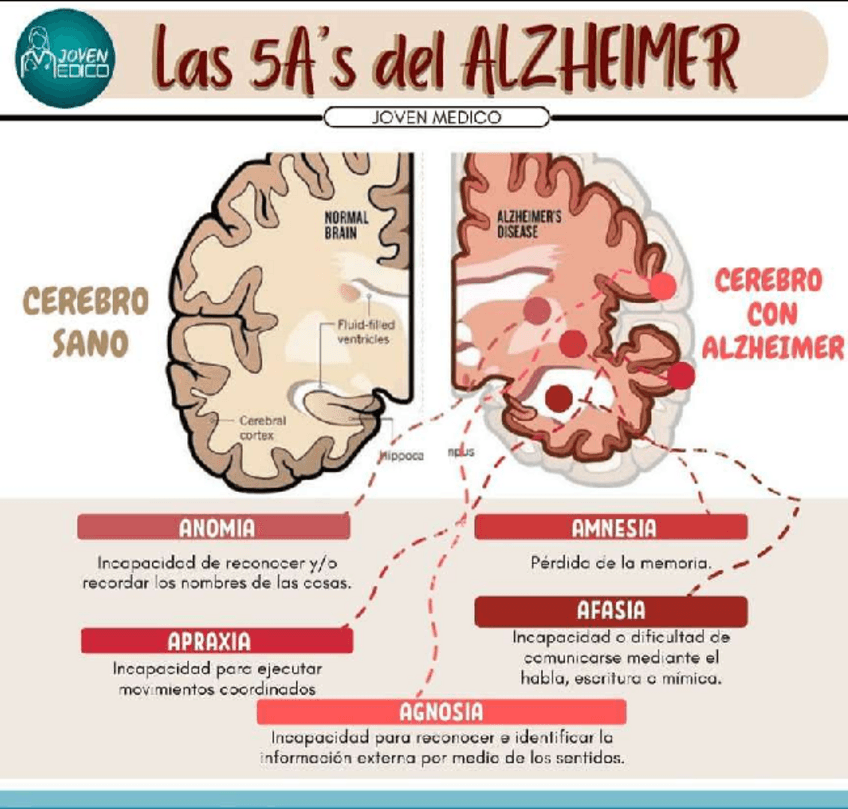 Miniatura del documento Las-Cinco-etapas-del-ALZHEIMER.pdf