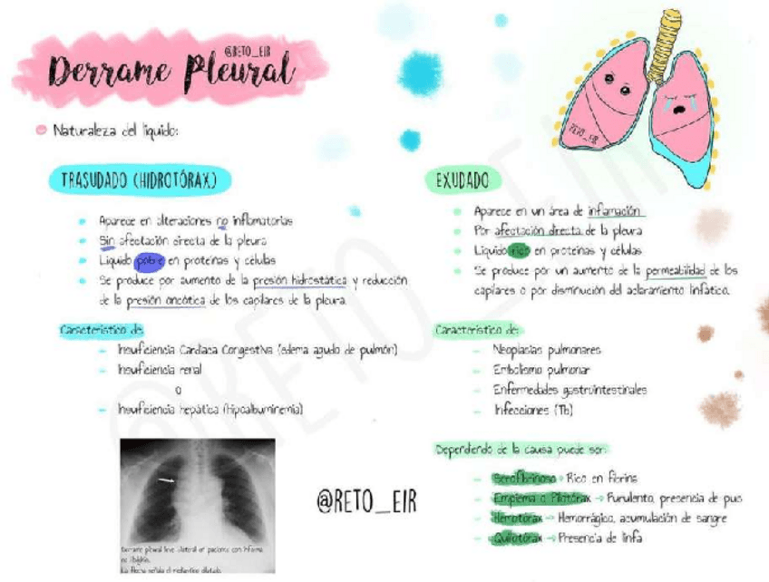 Miniatura del documento Derrame-Pleural.pdf