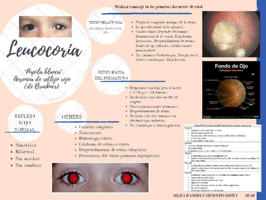 Miniatura del documento Leucocoria-Retinoblastoma.pdf